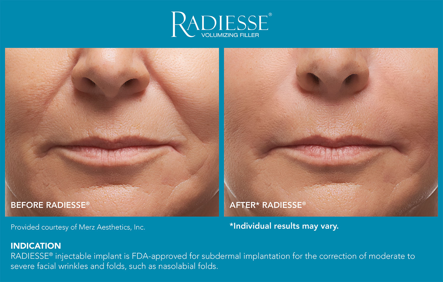 RadiesseBefore&After-0 2