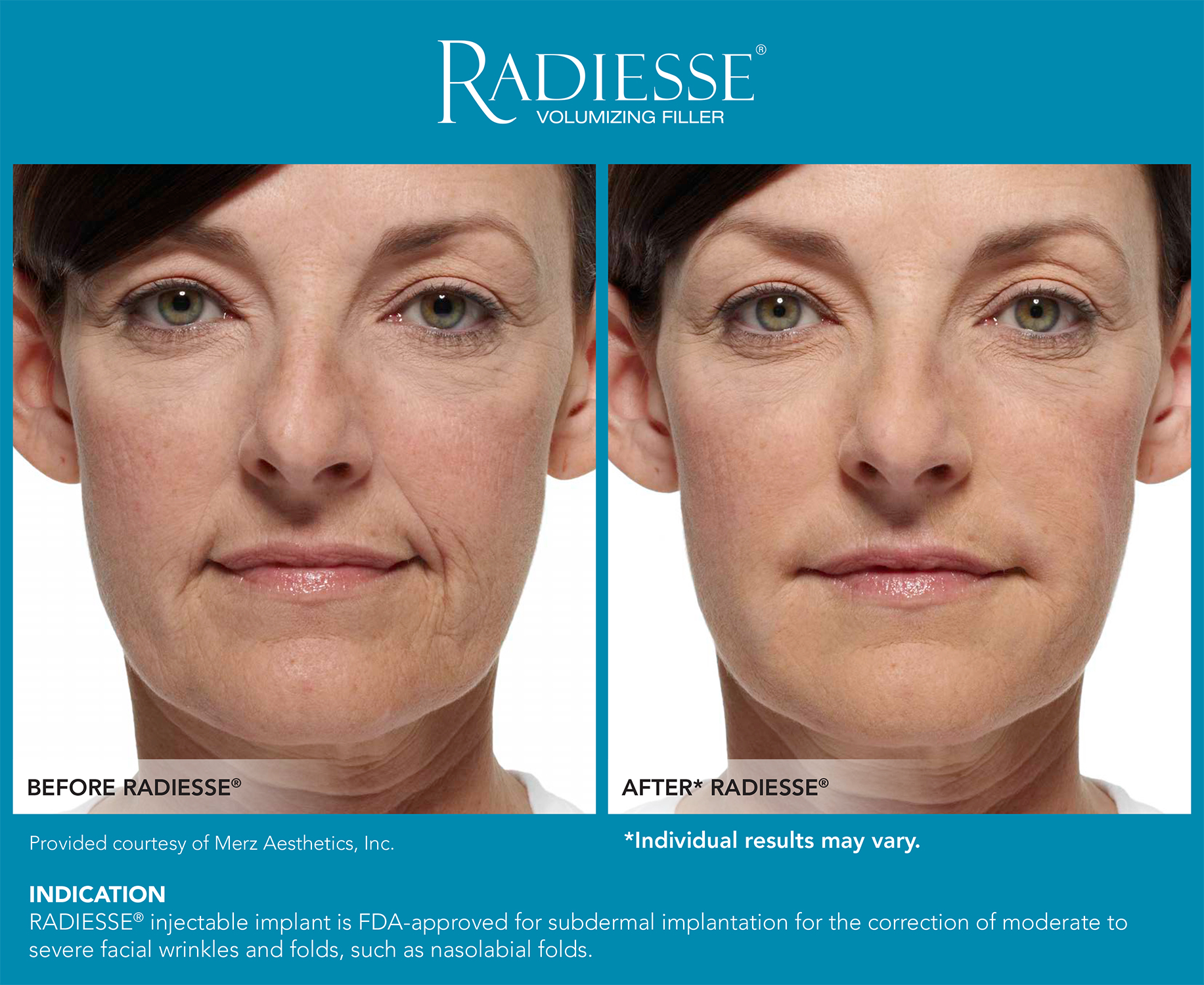 RadiesseBefore&After-0 3